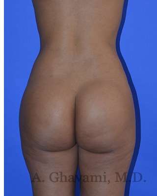 Buttock Augmentation Before & After Patient #7633