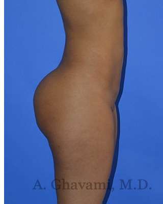 Buttock Augmentation Before & After Patient #7633