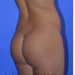 Buttock Augmentation Before & After Patient #7633