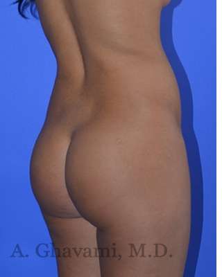 Buttock Augmentation Before & After Patient #7633