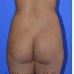 Buttock Augmentation Before & After Patient #7633