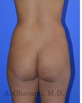 Buttock Augmentation Before & After Patient #7633