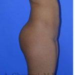 Buttock Augmentation Before & After Patient #7633