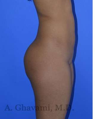 Buttock Augmentation Before & After Patient #7633