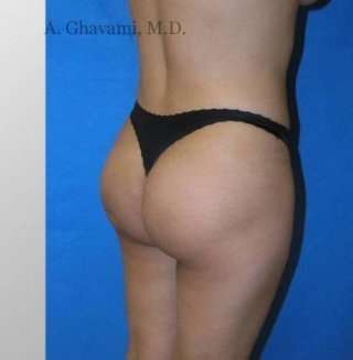 Buttock Augmentation Before & After Patient #7626