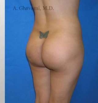 Buttock Augmentation Before & After Patient #7626