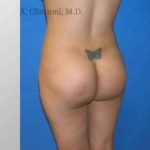 Buttock Augmentation Before & After Patient #7626