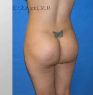 Buttock Augmentation Before & After Patient #7626