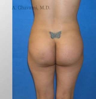 Buttock Augmentation Before & After Patient #7626