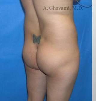 Buttock Augmentation Before & After Patient #7626