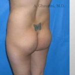 Buttock Augmentation Before & After Patient #7626