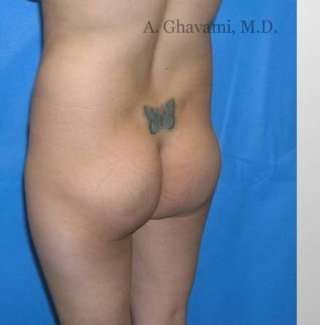 Buttock Augmentation Before & After Patient #7626