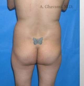 Buttock Augmentation Before & After Patient #7626
