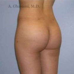 Buttock Augmentation Before & After Patient #7617