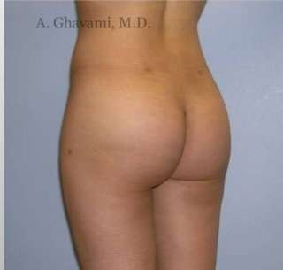 Buttock Augmentation Before & After Patient #7617