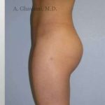 Buttock Augmentation Before & After Patient #7617