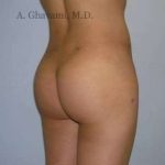 Buttock Augmentation Before & After Patient #7617