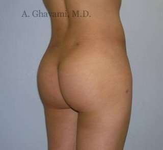 Buttock Augmentation Before & After Patient #7617