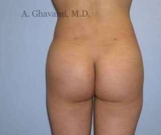 Buttock Augmentation Before & After Patient #7617
