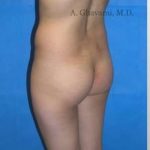 Buttock Augmentation Before & After Patient #7617