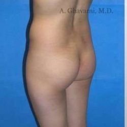 Buttock Augmentation Before & After Patient #7617