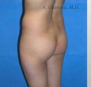 Buttock Augmentation Before & After Patient #7617