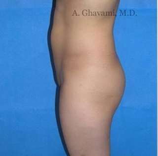 Buttock Augmentation Before & After Patient #7617