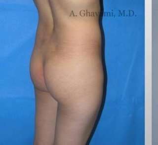 Buttock Augmentation Before & After Patient #7617