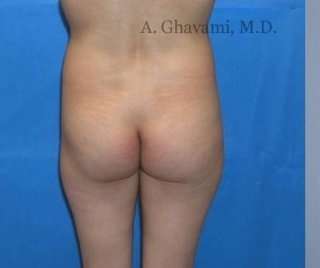Buttock Augmentation Before & After Patient #7617