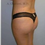 Buttock Augmentation Before & After Patient #7608