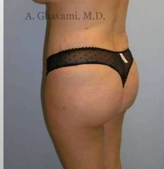 Buttock Augmentation Before & After Patient #7608