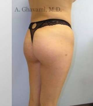 Buttock Augmentation Before & After Patient #7608
