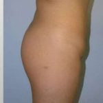 Buttock Augmentation Before & After Patient #7608