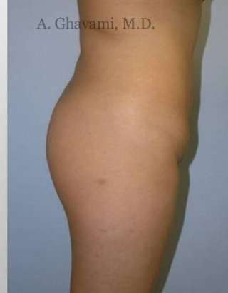 Buttock Augmentation Before & After Patient #7608