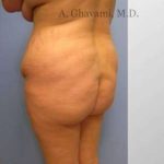 Buttock Augmentation Before & After Patient #7608