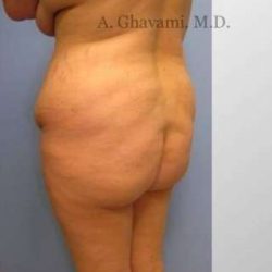Buttock Augmentation Before & After Patient #7608