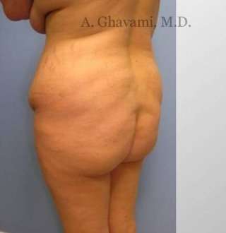 Buttock Augmentation Before & After Patient #7608