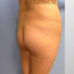 Buttock Augmentation Before & After Patient #7608