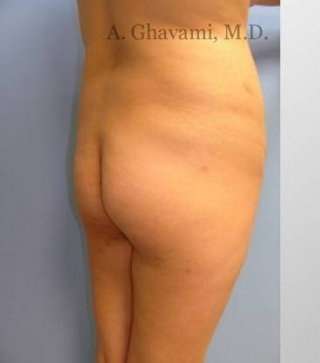 Buttock Augmentation Before & After Patient #7608
