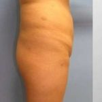 Buttock Augmentation Before & After Patient #7608