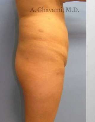 Buttock Augmentation Before & After Patient #7608