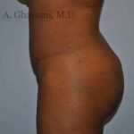 Buttock Augmentation Before & After Patient #7601