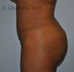 Buttock Augmentation Before & After Patient #7601