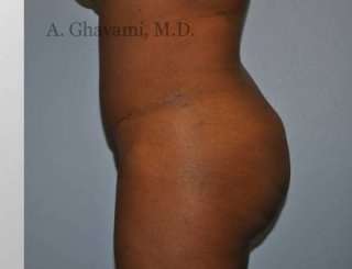 Buttock Augmentation Before & After Patient #7601