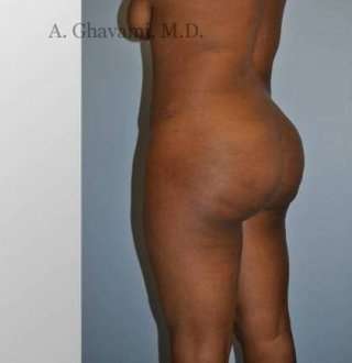 Buttock Augmentation Before & After Patient #7601