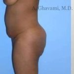 Buttock Augmentation Before & After Patient #7601