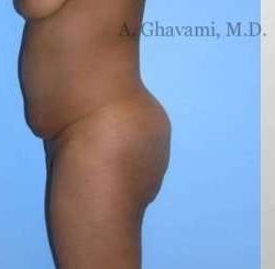 Buttock Augmentation Before & After Patient #7601