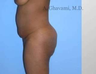 Buttock Augmentation Before & After Patient #7601