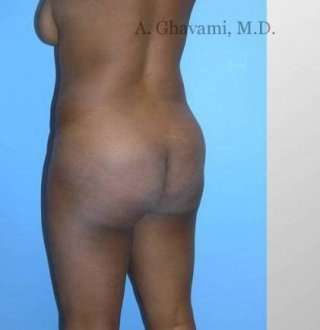 Buttock Augmentation Before & After Patient #7601