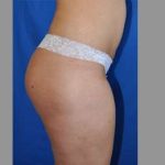 Buttock Augmentation Before & After Patient #7596
